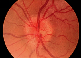 后葡萄膜炎视神经发炎令视神经充血和水肿不错，可严重影响视力