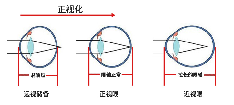 眼睛正视化，近视过程.jpg