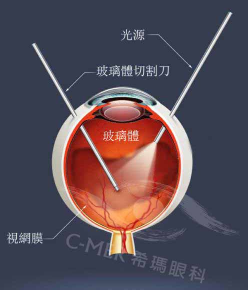 玻璃体